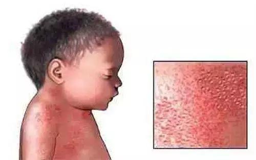 宝宝湿疹终于好了,宝宝湿疹治愈经历