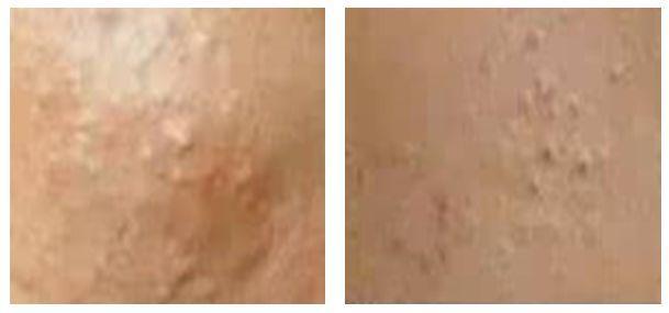 闭口痘痘推荐药膏,治疗粉刺闭口痘印药膏