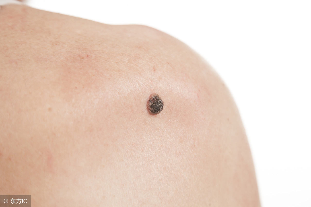 皮肤癌扩散放疗后活多久,皮肤癌放疗后怎么复查