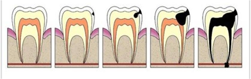 儿童换牙期常见牙齿问题,小朋友换牙新牙已出旧牙没松咋办