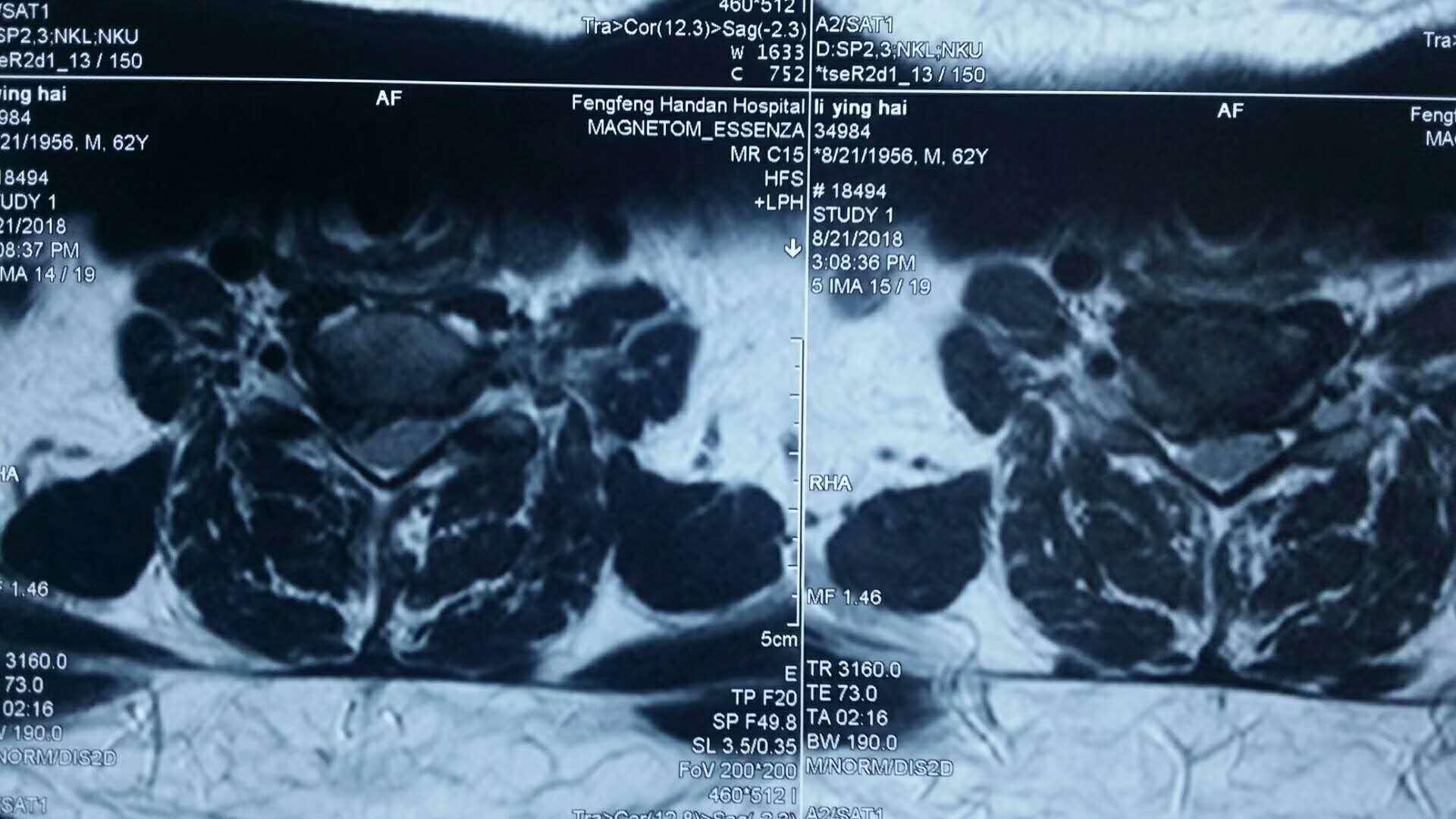 邯郸中心医院颈椎科,delta治疗颈椎
