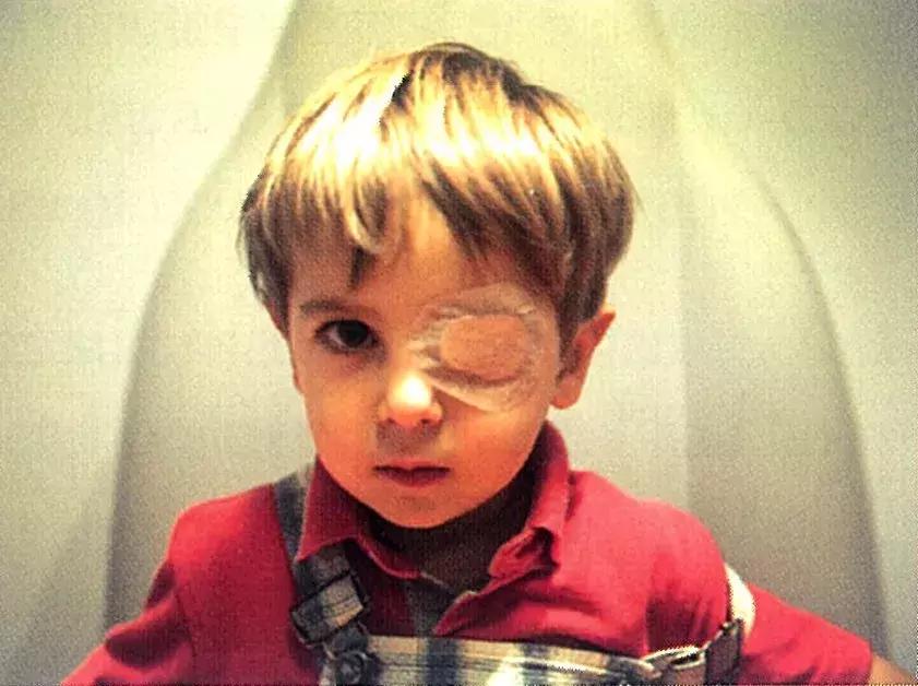 传统过时的弱视治疗方法（上）