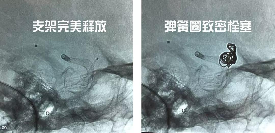 颅内动脉瘤血管内介入治疗新进展,颅内动脉瘤微创介入栓塞治疗