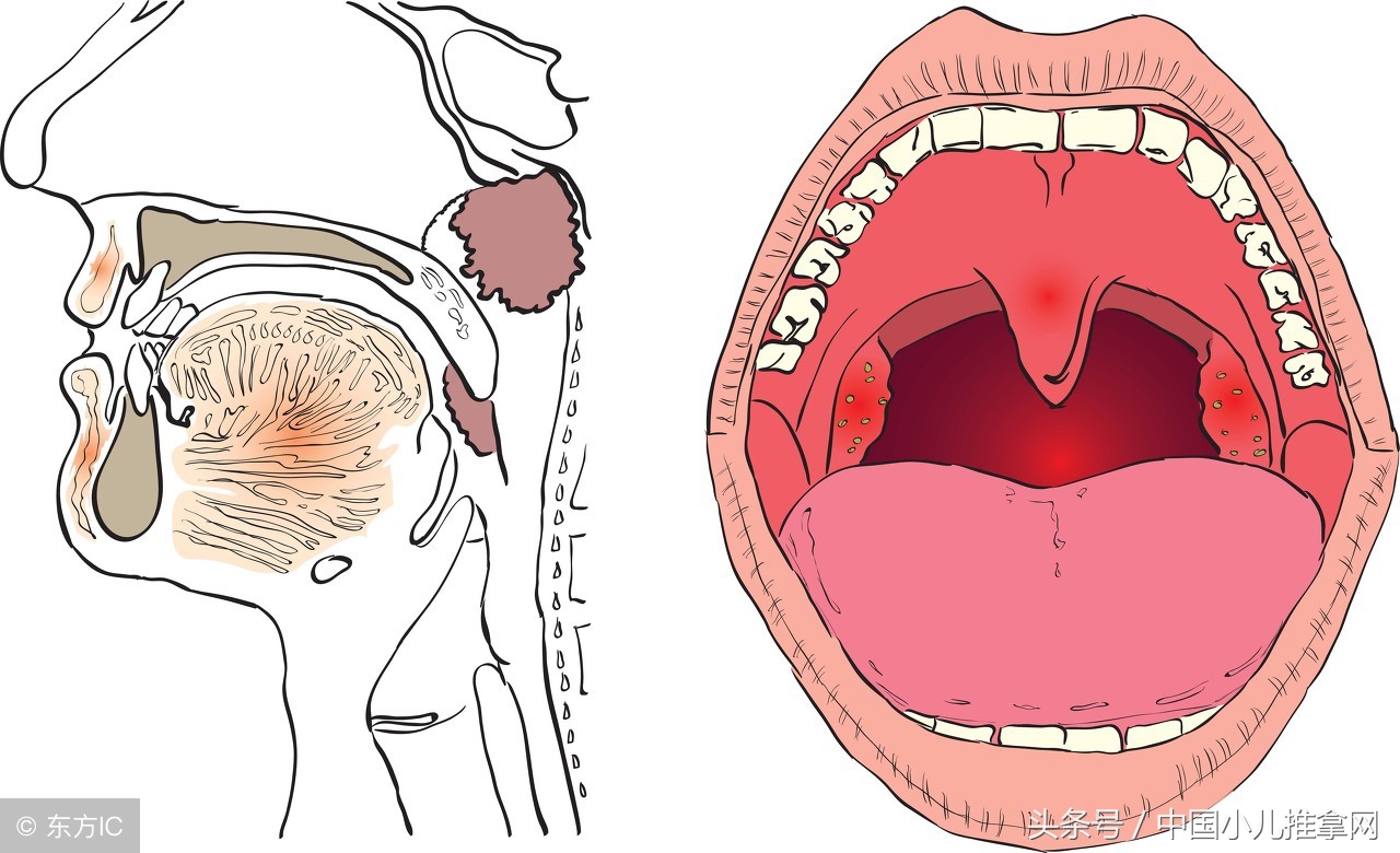 小儿推拿鼻炎腺样体肥大手法,腺样体肥大的小儿推拿疗法