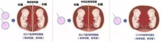 在娘胎里“亲密接触”,这对双胞胎差点“玩”出大祸……