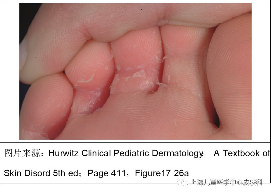 一岁宝宝有脚气怎么办,宝宝怎么会得脚气