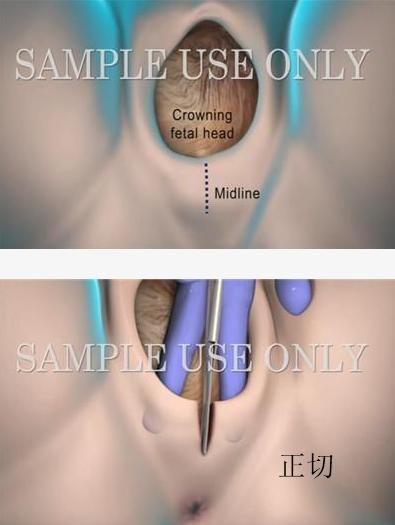 顺产除了无痛针还有什么可以止痛,顺产侧切有疤痕吗