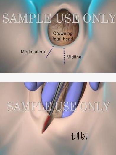 顺产除了无痛针还有什么可以止痛,顺产侧切有疤痕吗