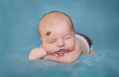 小宝宝额头上胎记,宝宝左右肩膀上有胎记代表什么