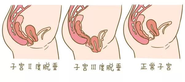 子宫脱垂的诊断和鉴别诊断,子宫脱垂不同程度的区分
