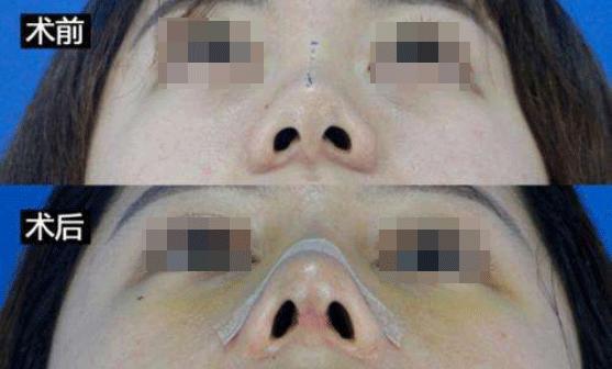 为什么有的人隆鼻成功有的失败,揭秘医生都不会说的隆鼻内幕