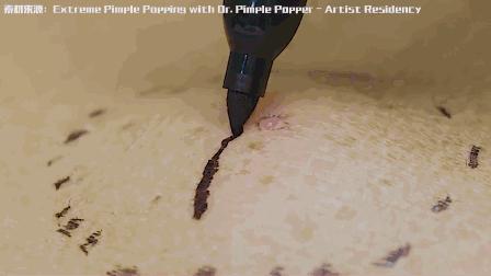 为啥那么多人爱看挤痘,为啥喜欢看挤痘痘