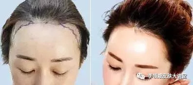 毛发移植术亲身经历,杏林毛发移植手术