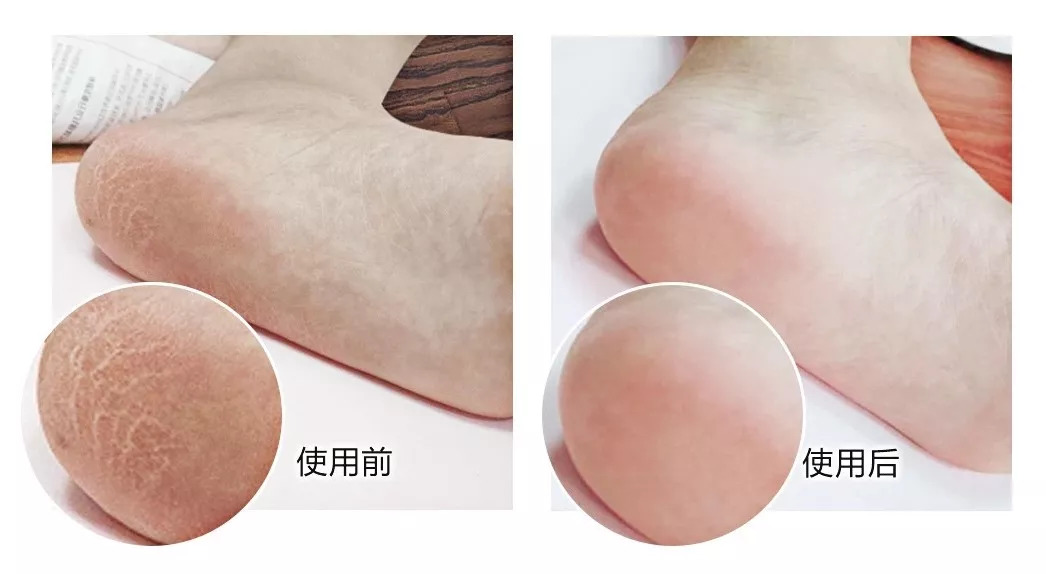 脚部干裂起皮用它一抹全搞定,脚后跟干裂好物推荐