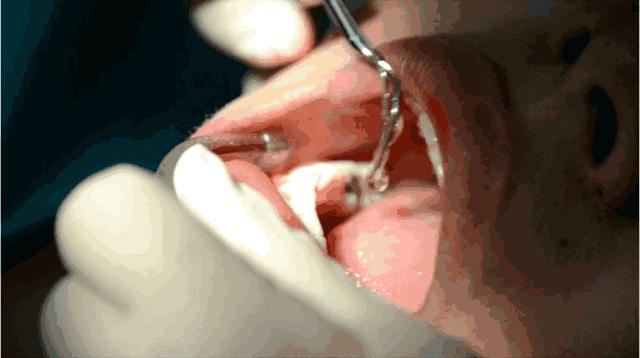 洗牙=牙缝变宽？这些黑锅，“洗牙”可不背！