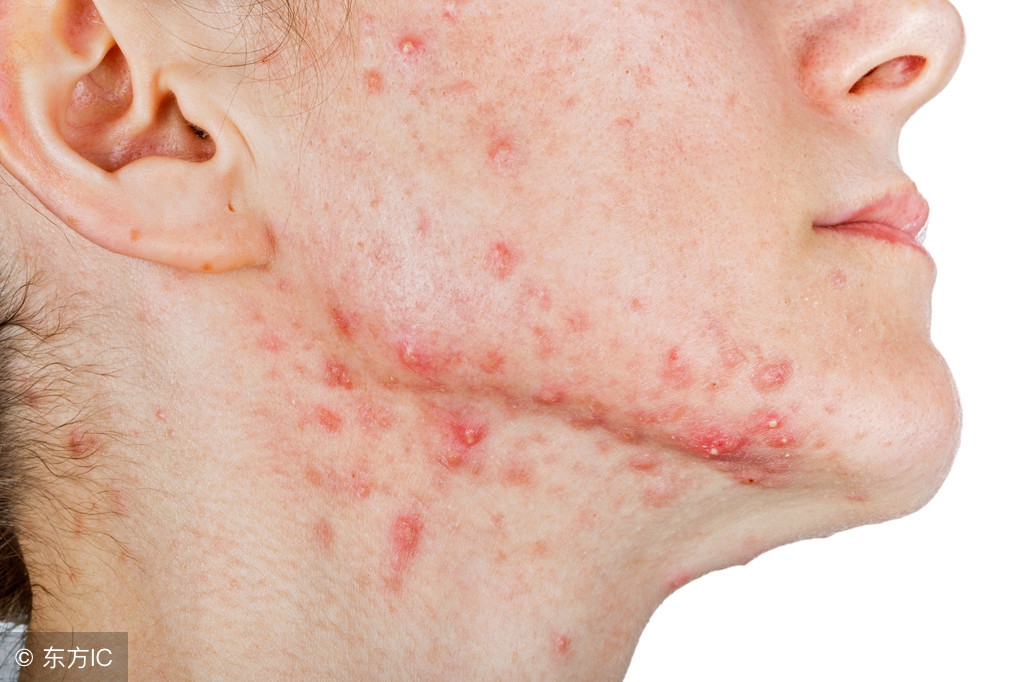 男生脸上有痘解决方法,脸上长痘应如何解决男