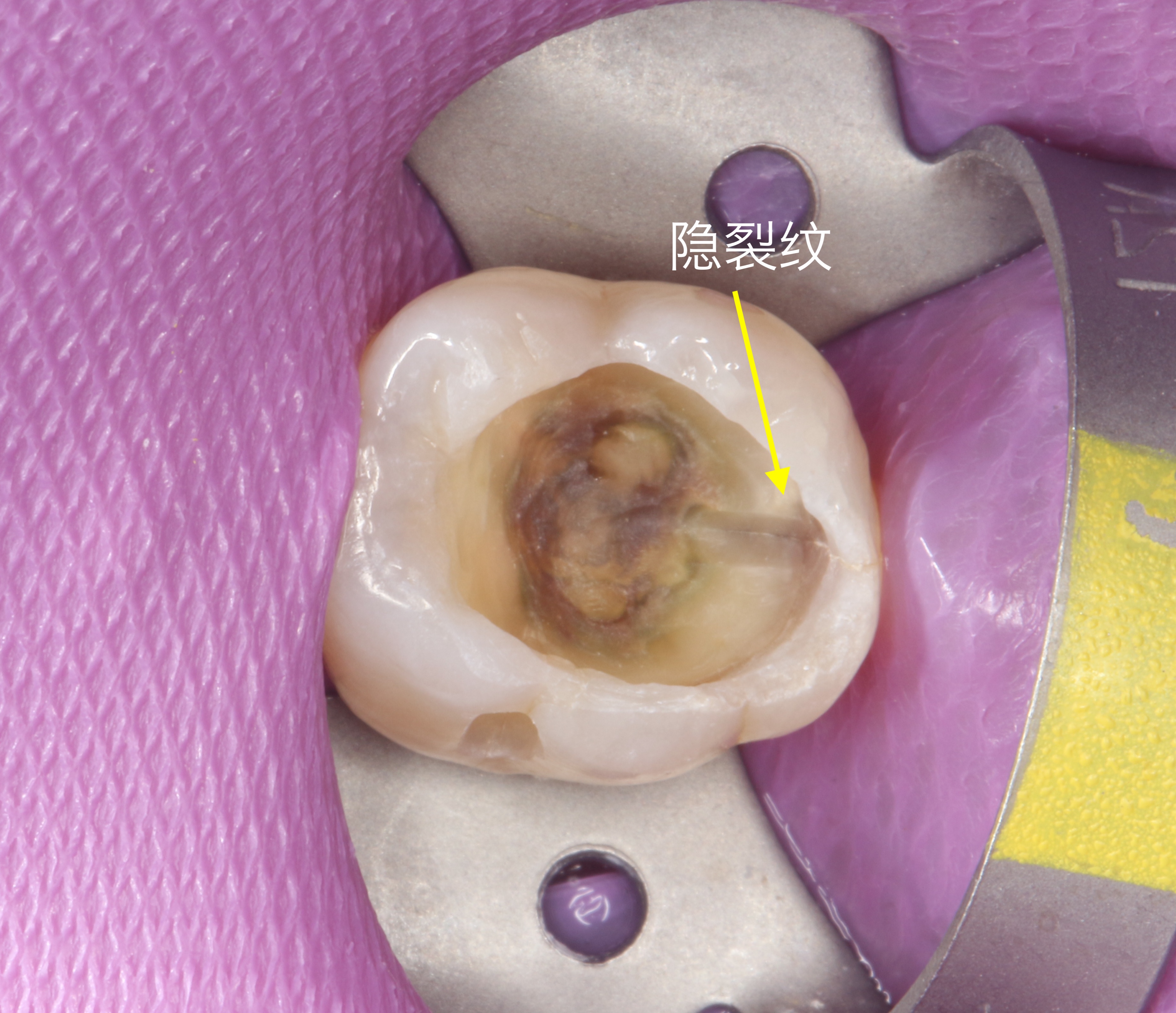 浅隐裂牙怎么处理,隐裂牙有自愈的可能