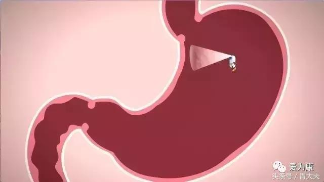 胶囊机器人胃镜可以检查哪些,黑科技胃镜胶囊和普通胃镜