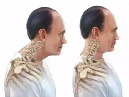 18岁脖子后面颈椎凸起怎么办,脖子后面长了一个包挂什么科