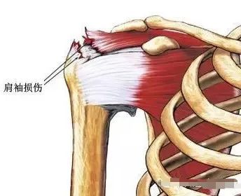 肩峰下撞击综合征影像表现,肩峰撞击综合征推拿治疗