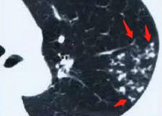 肺结核治疗4个月，这位酷似吴彦祖的帅小伙嘟囔：我想女朋友了！