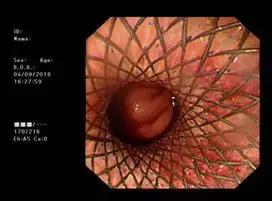 食管癌吞不下饭怎么办,食管肿瘤吃不下东西怎么减轻痛苦