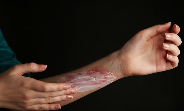 手术后切口是怎么愈合的,手术切口愈合分为哪三期