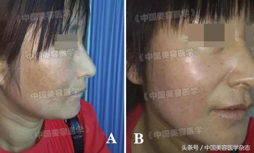 中药调理褐斑一般多久能见效,中药和针灸调理黄褐斑