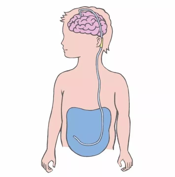 新生儿脑积水有什么症状,老年人脑积水的症状及治疗