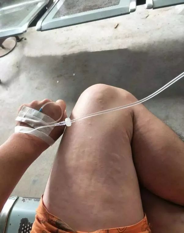 广西蚂蚁咬人事件,广西有种蚂蚁被咬全身痒