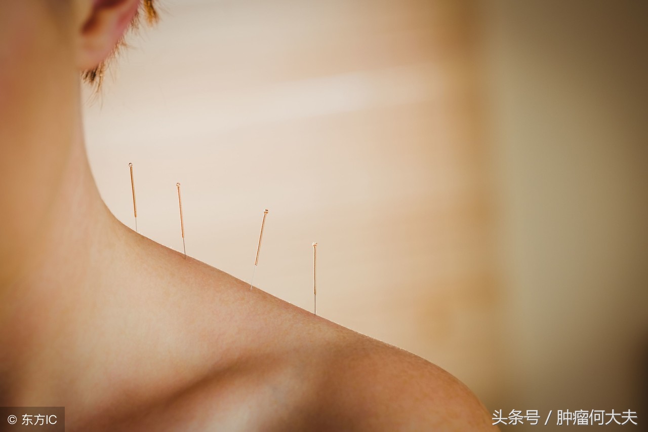 针灸治疗癌症最好的方法,针灸治疗癌症最好的穴位