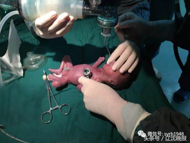 奇迹！出生时仅1.17斤！沈阳这位极早早产宝宝就要出院了！