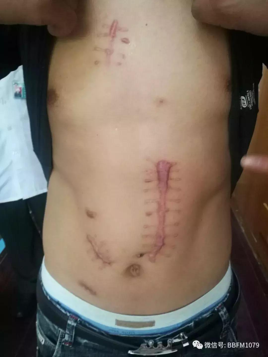 安徽8岁男童被砍死后续,2名孩子被拿斧头砍后续