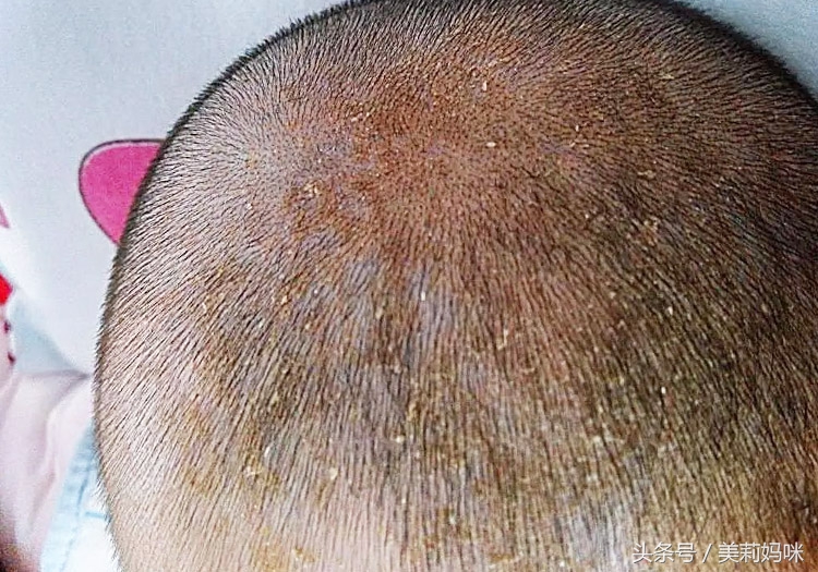 新生儿乳痂如何清除,如何处理新生儿脸上的乳痂