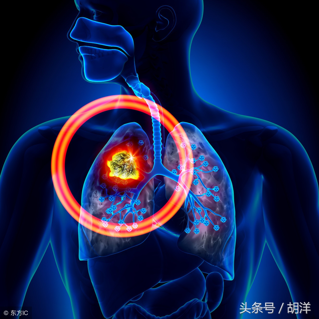 肺癌基因检测egfr是什么意思,肺癌中egfr是属于基因检测吗