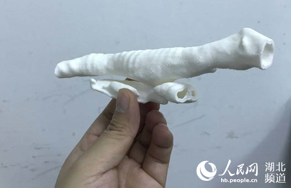 3d打印支气管支架技术,气管瘘支架植入术的利弊