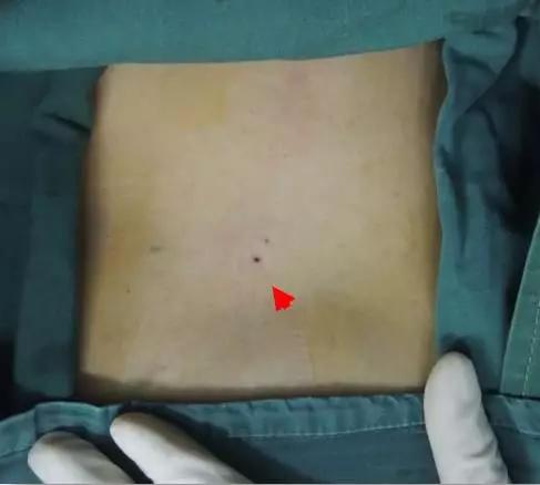 腰椎间盘突出激光汽化手术缺点,腰椎间盘突出的骨刺能用激光吗