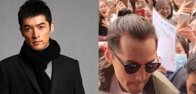 有许多明星脱发是怎样补救的,明星脱发都用什么方法