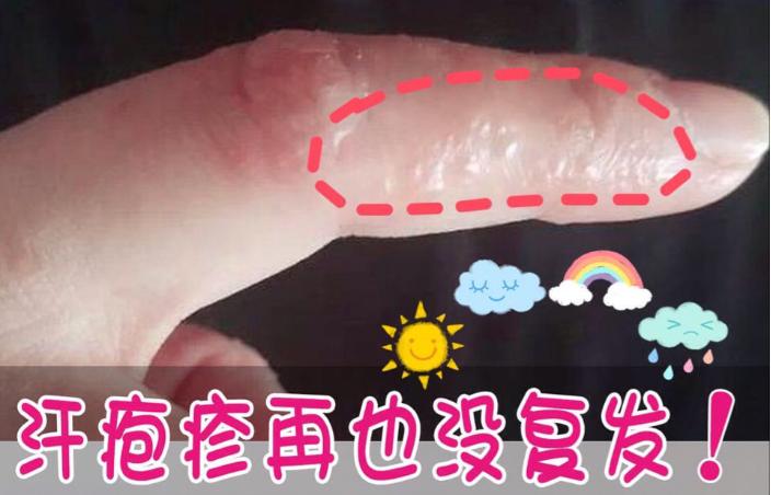 手上长很痒的小包是怎么回事,手上长的汗疱疹怎么快速止痒