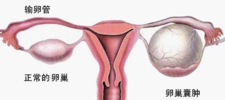 卵巢囊肿，究竟要不要手术？