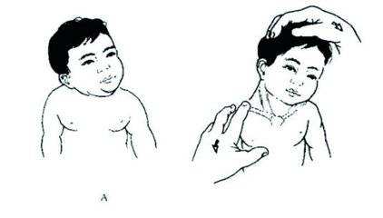 治疗小儿斜颈最好医院,斜颈分哪种类型