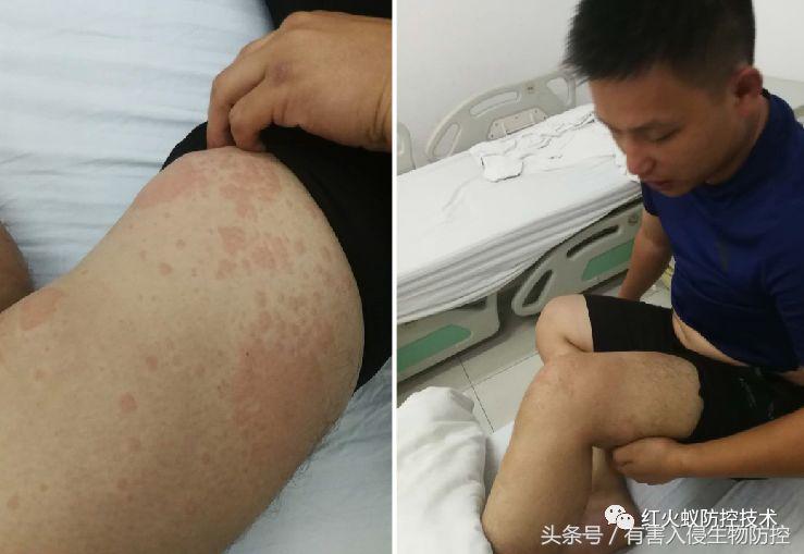 被红火蚁咬的治疗方法,被红火蚁咬后怎么处理偏方