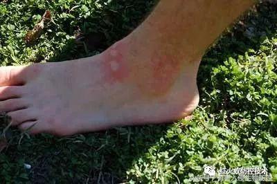 被红火蚁咬的治疗方法,被红火蚁咬后怎么处理偏方
