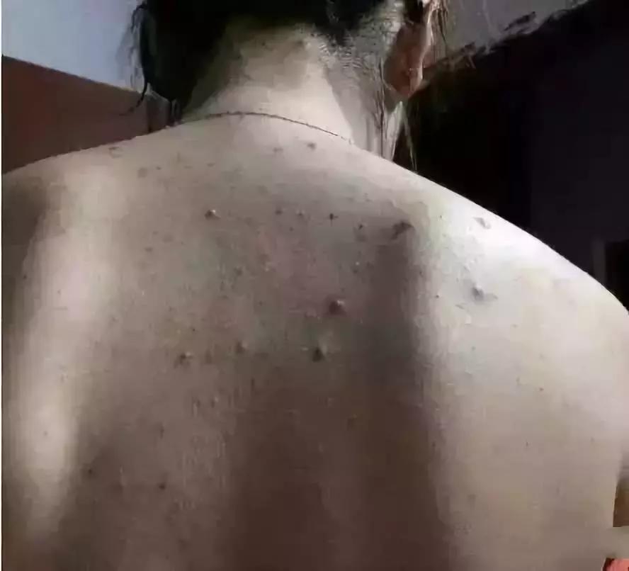 后背挤出来像小米粒怎么办,后背为啥长小米粒