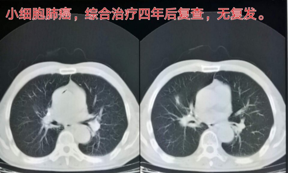 癌症晚期带病长期生存,癌症患者的生存记录