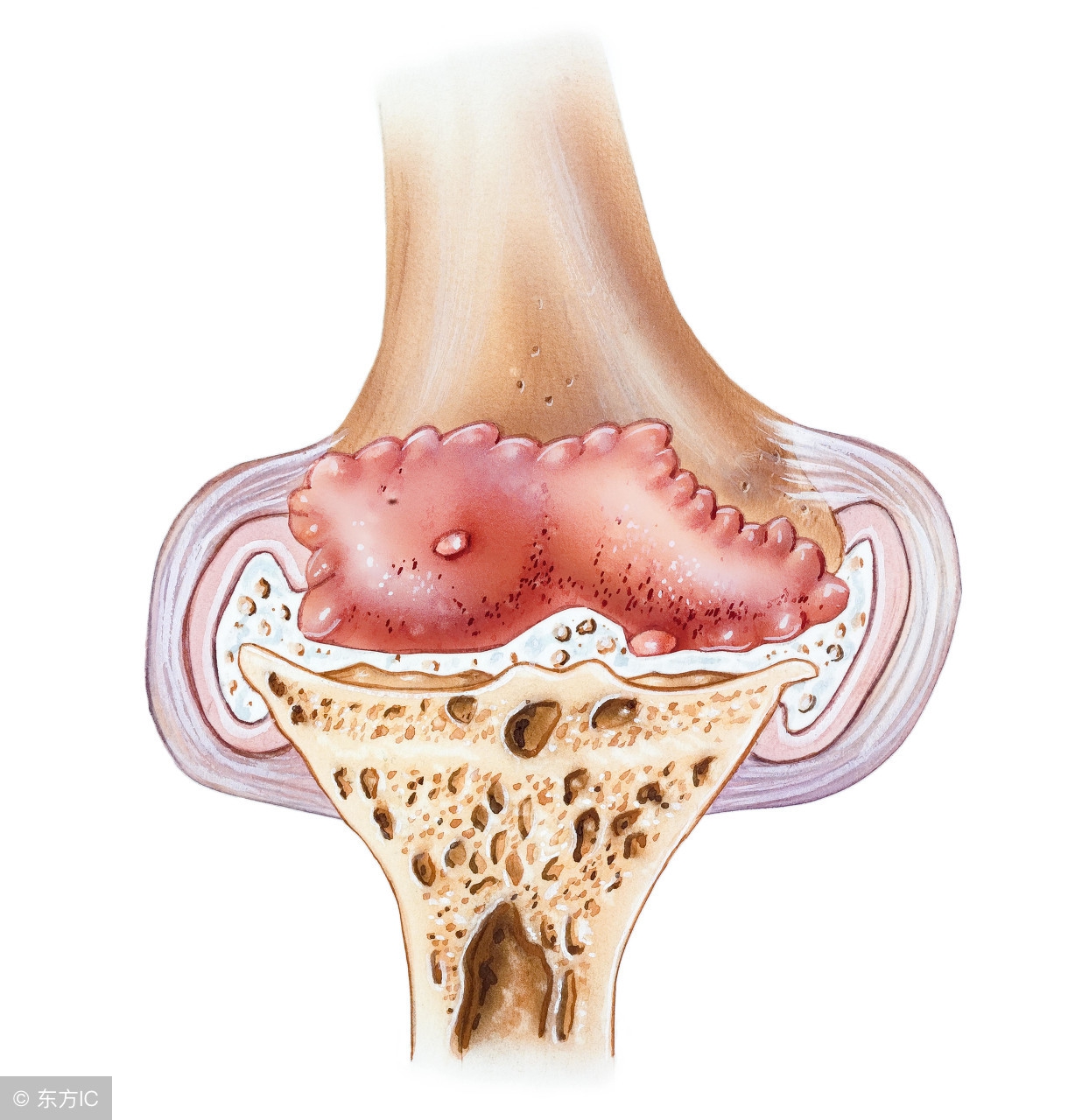骨刺真的那么重要么,骨刺真的那么可怕吗