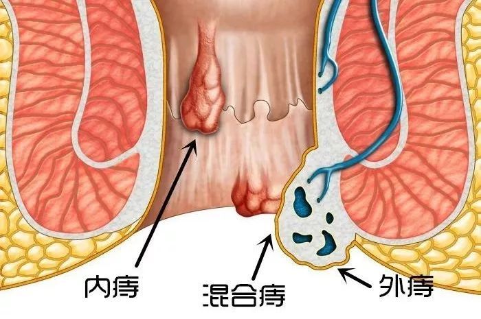久蹲马桶也可能得病！据说十个人里九个人都有……5步帮你自查