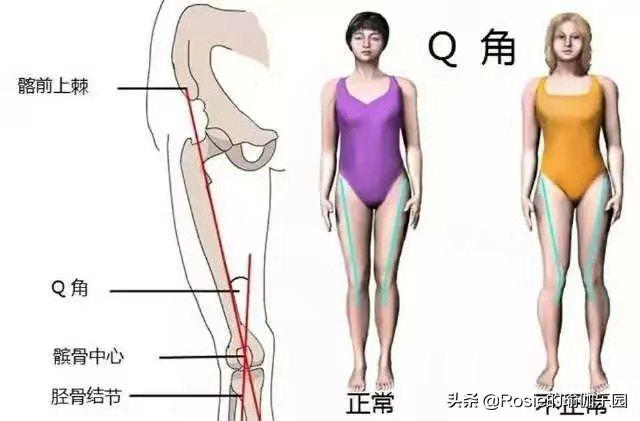 膝盖内扣扁平足怎么矫正,膝盖内扣怎么矫正腿型13岁