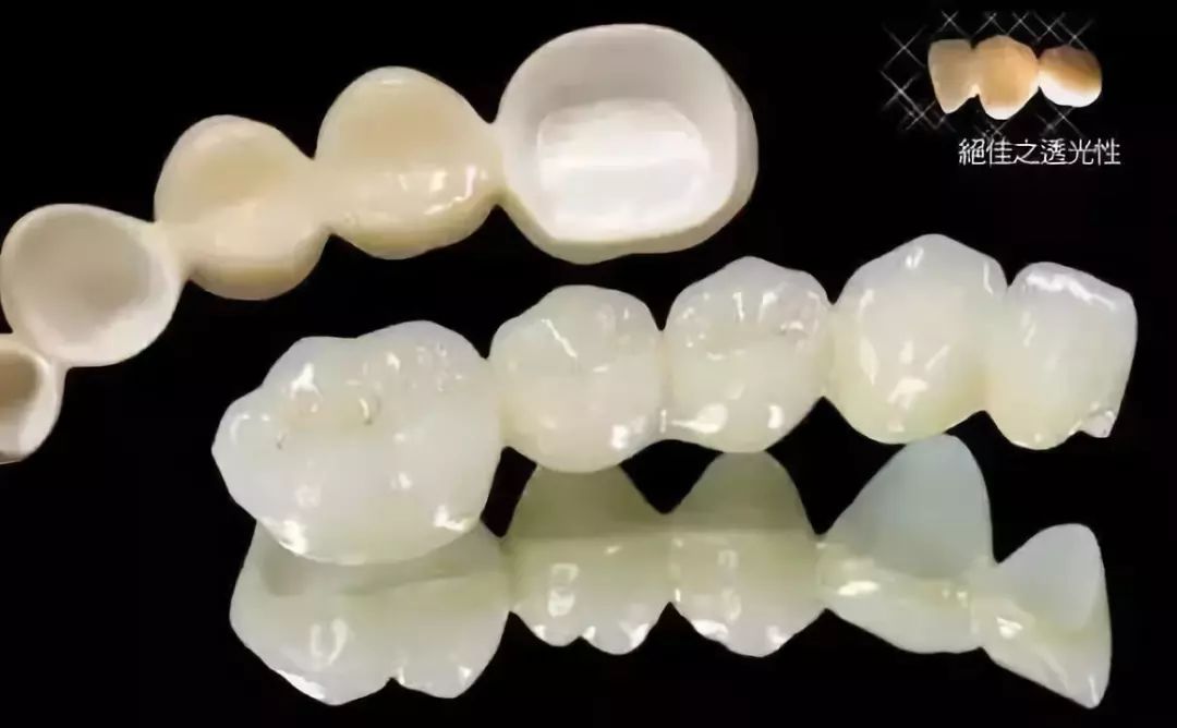 烤瓷牙与全瓷牙价格相差近十倍?究竟贵在哪?