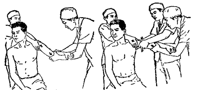 中医骨折治疗原则,中医骨伤整复术